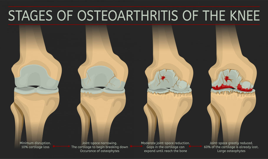 Exercising with Osteoarthritis in Your Knee