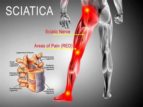 How To Workout w/ Sciatic Pain